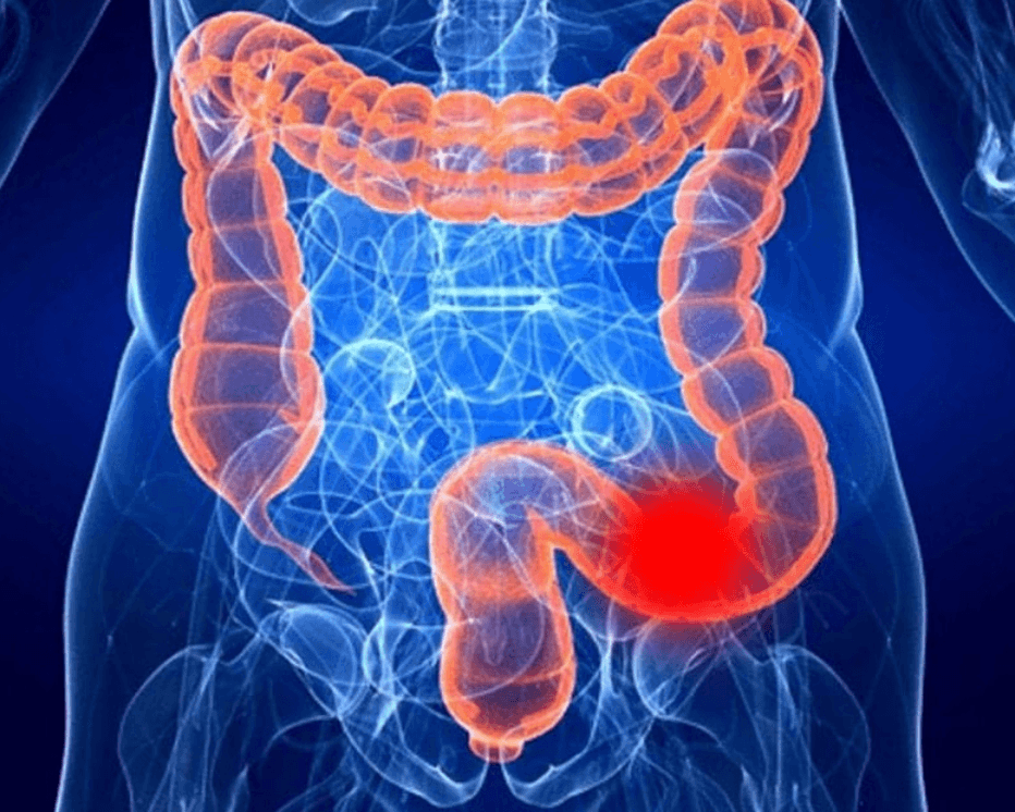 Рак толстой кишки: современный взгляд