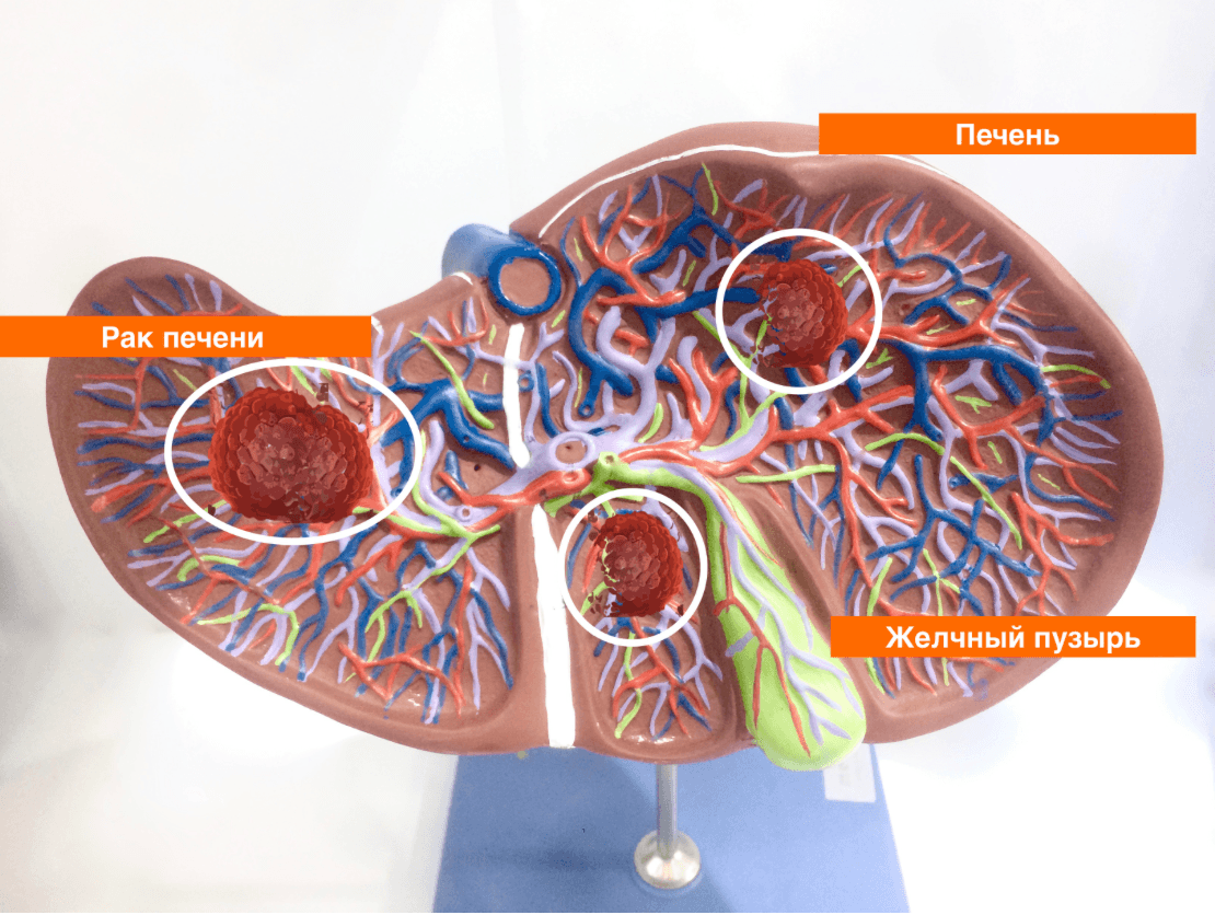Рак печени: риски, симптомы и новые возможности терапии