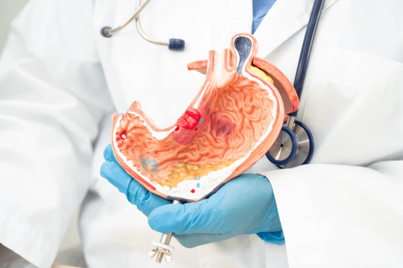 Рак желудка: современные данные, виды, лечение и прогноз