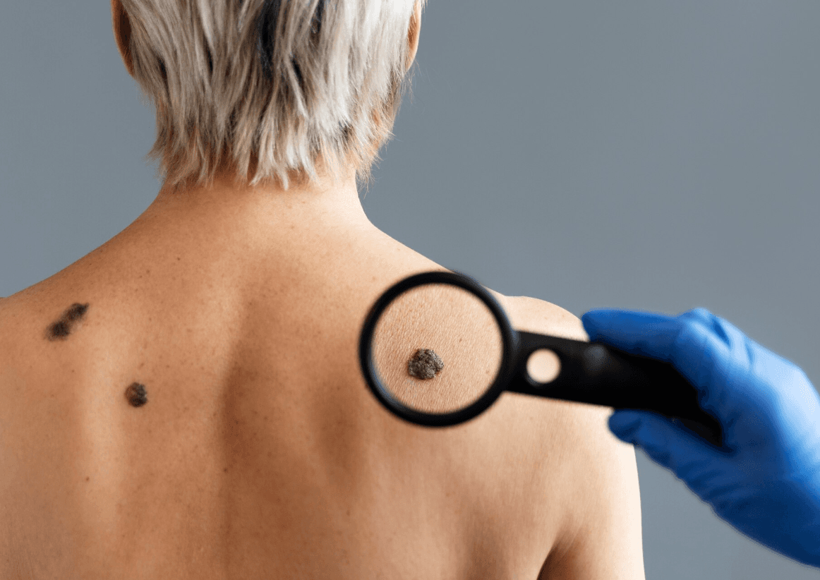 Рак кожи: не только от солнца